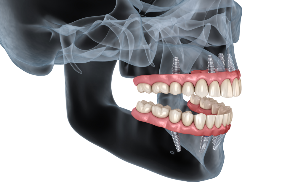 visual representation of how all-on-4 dental implants work